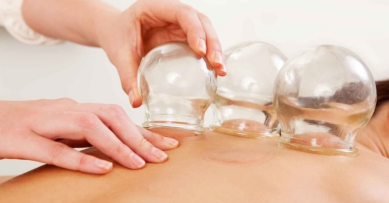 Discover the Benefits of Chinese Cupping Therapy in Singapore